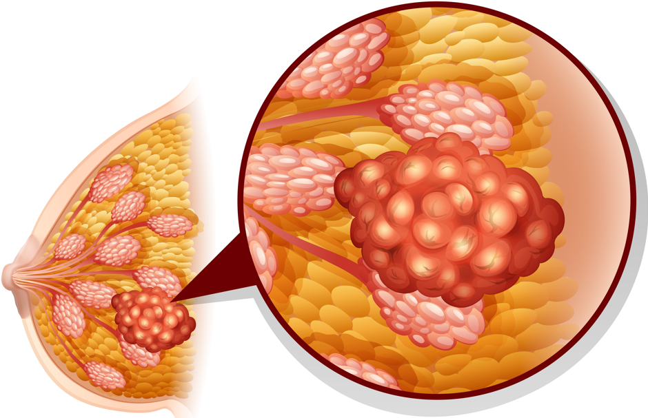 Breast Cancer